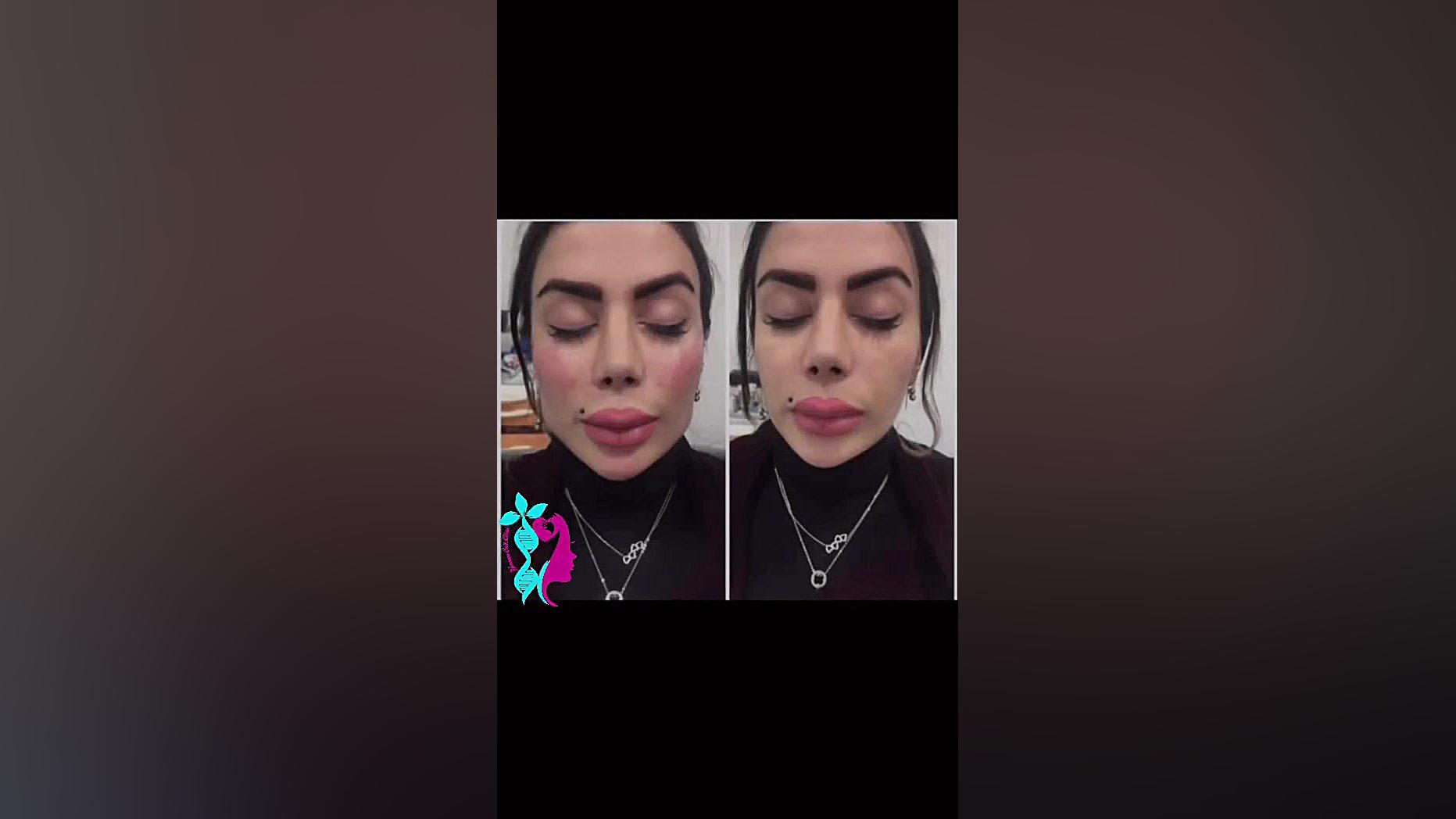 فیلم زاویه سازی صورت (کانتورینگ) آزمون ایمونوفیکساسیون