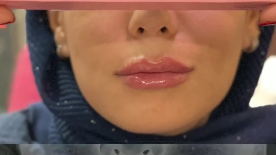 فیلم تزریق فیلر لب دکتر علیرضا بابایی،فوق تخصص جراحی پلاستیک و زیبایی