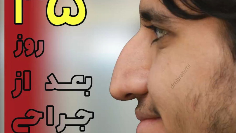 رضایتمندی بیمار بعد از جراحی بینی توسط دکتر امید ابراهیمی دکتر امید ابراهیمی