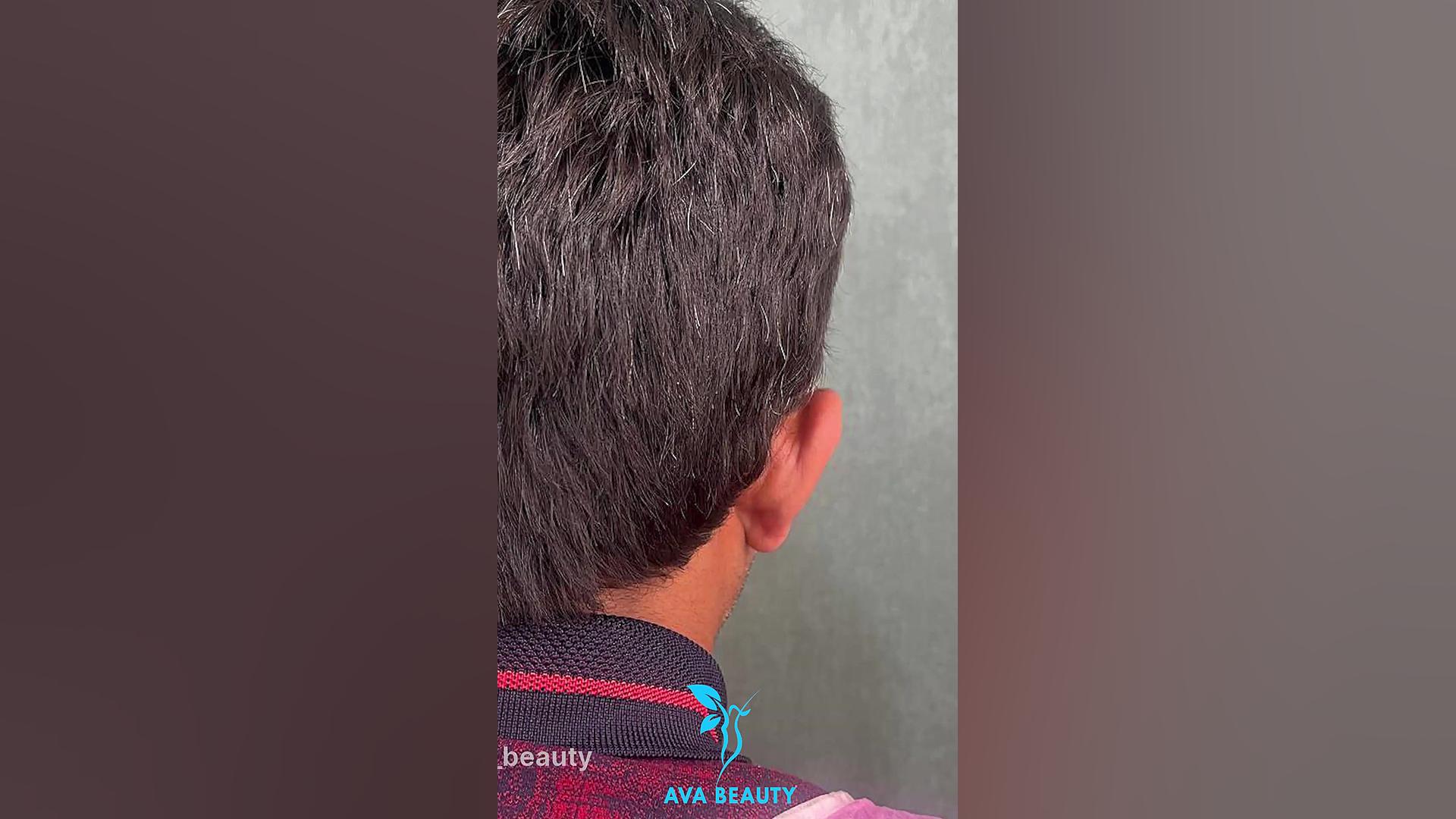 نمونه کار عمل زیبایی گوش بیماری منیر