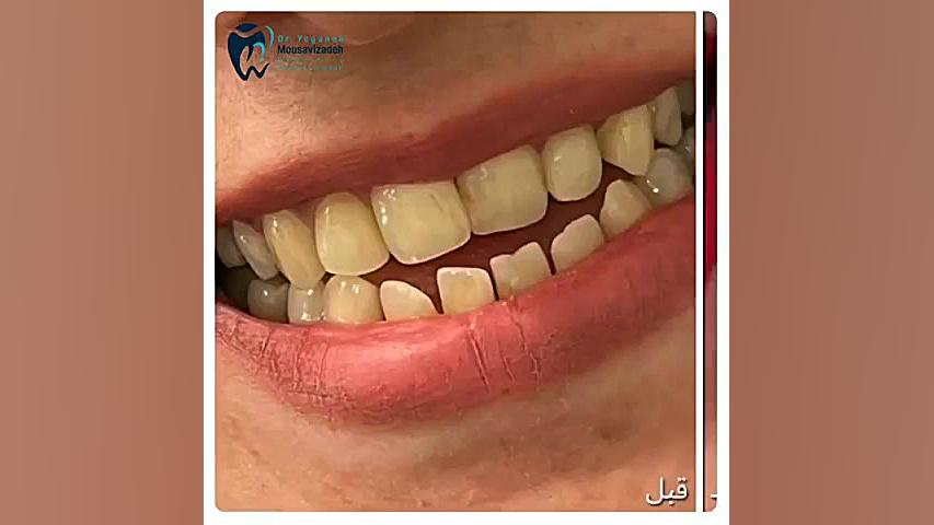 اصلاح لبخند با ونیر کامپوزیت اندودنتیکس