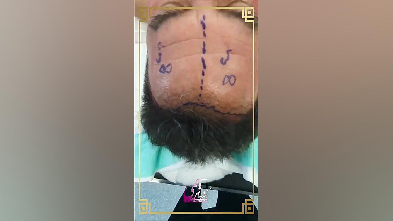 جراحی لیفت پیشانی اوتیلومیومبر