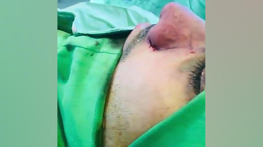 نمونه کار بعد از عمل انحراف بینی دکتر سعید مرزبان