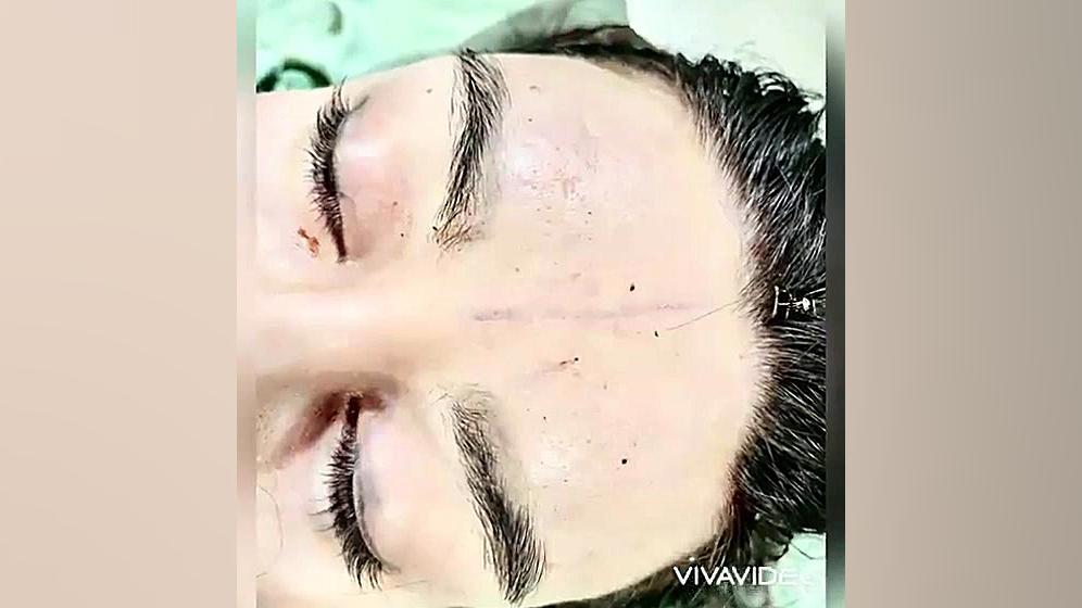 عمل جراحی لیفت اندوسکوپی پیشانی وابرو دکتر سعید مرزبان