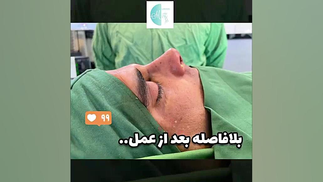 قبل وبعد عمل جراحی زیبایی بینی دکتر سعید مرزبان