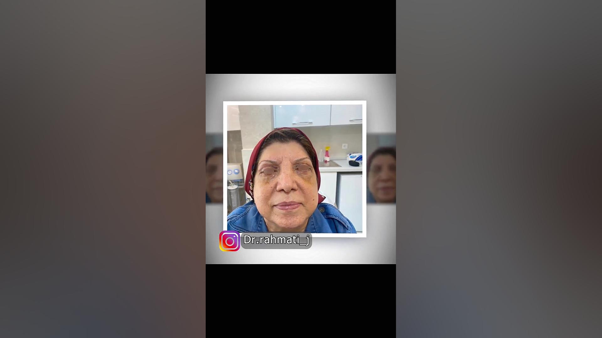 بلفاروپلاستی پلک پایین دکتر جواد رحمتی