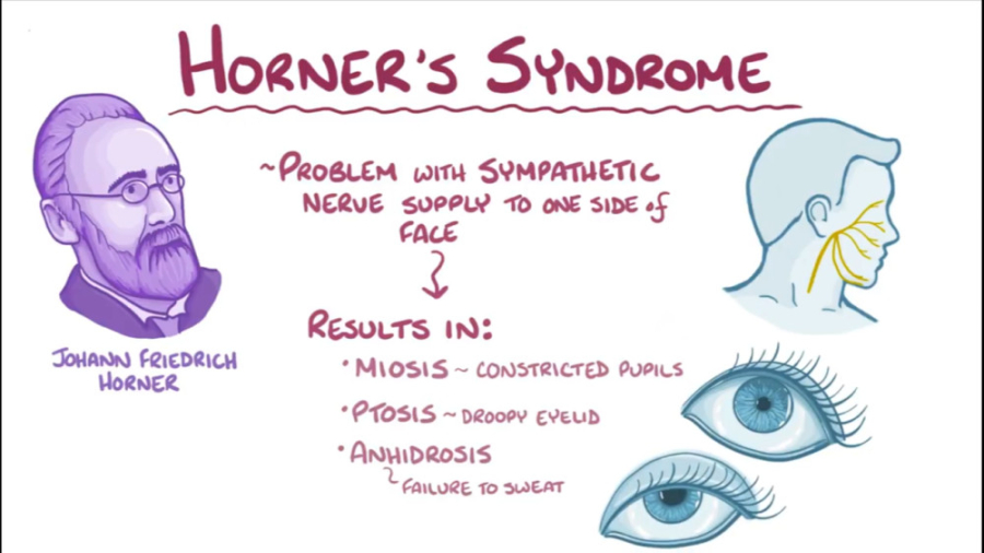 سندروم هورنر (Horner's syndrome) - اسموزیس آزمون NanoString