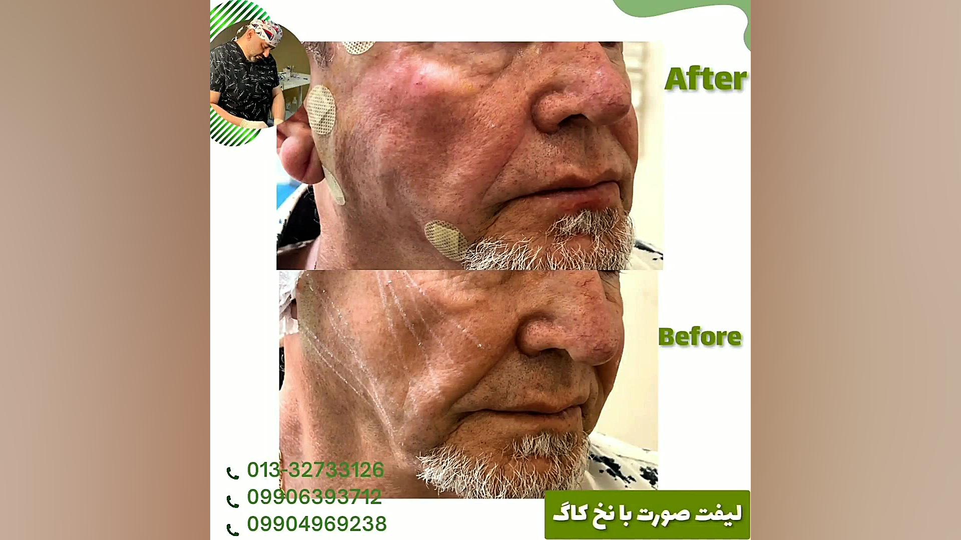 لیفت صورت با نخ دکتر شهروز امانی دیسمورفی فاسیال