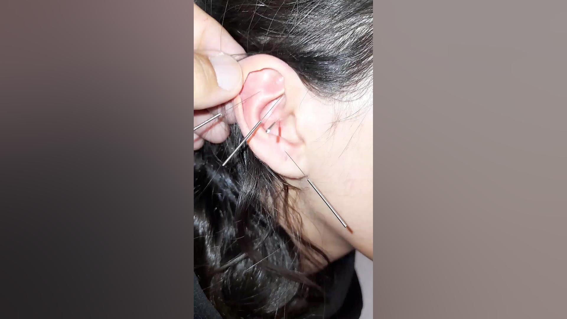 آموزش سوزنی درمان میگرن ازادبخت درمان جای جوش