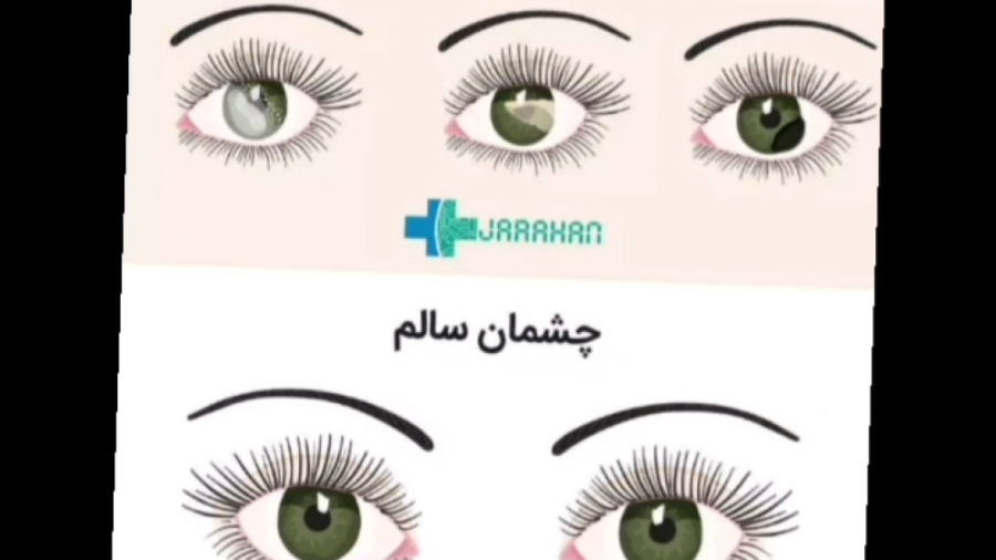 آب سیاه،پیشگیری___Glaucoma,prevention تزریق ژل