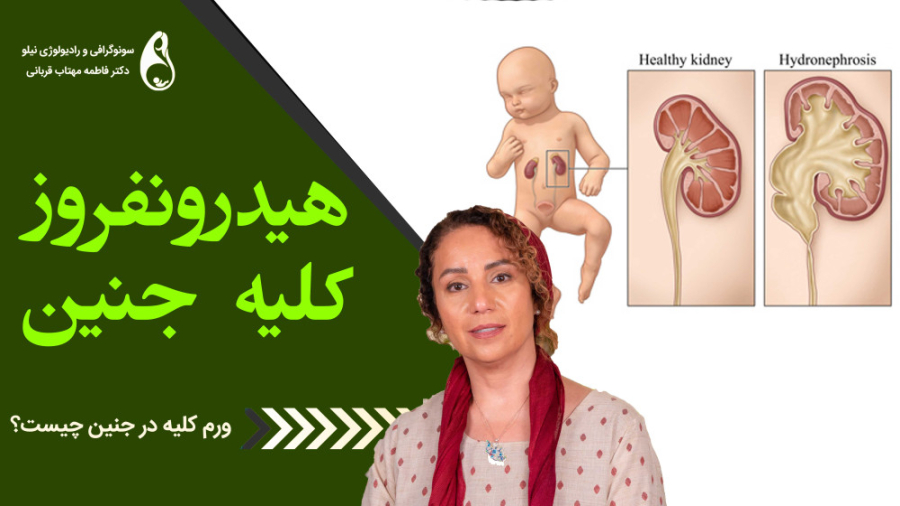 هیدرونفروز کلیه جنین - ورم کلیه جنین سونوگرافی نیلو دکتر فاطمه مهتاب قربانی