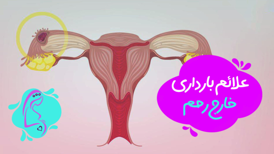 علائم بارداری خارج از رحم