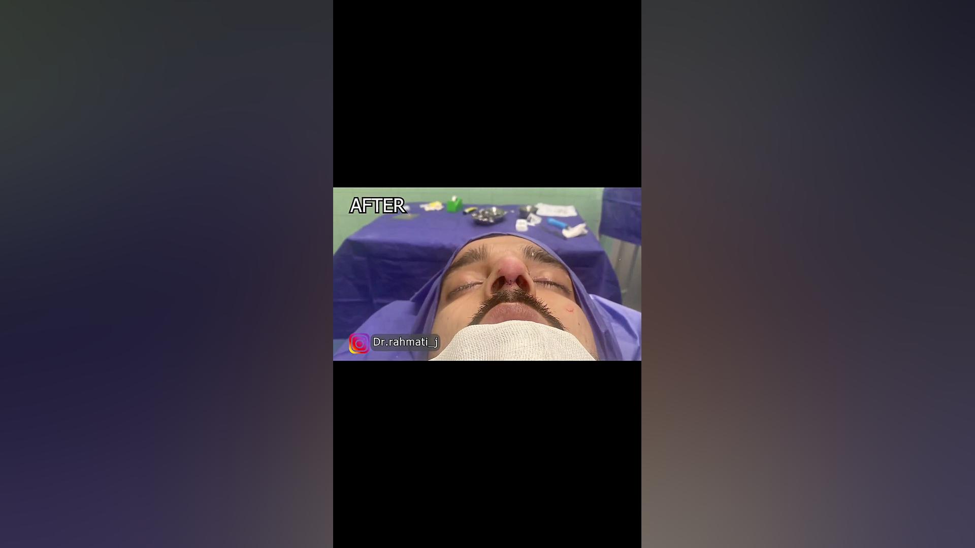 جراحی بینی مردانه فوق العاده طبیعی دکتر جواد رحمتی