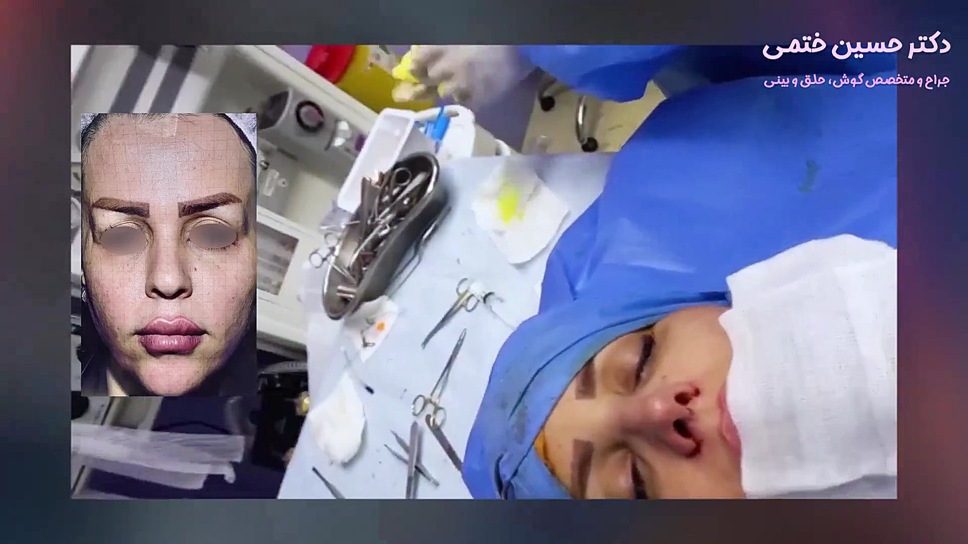 فیلم عمل بینی اتاق عمل پر کردن دندان