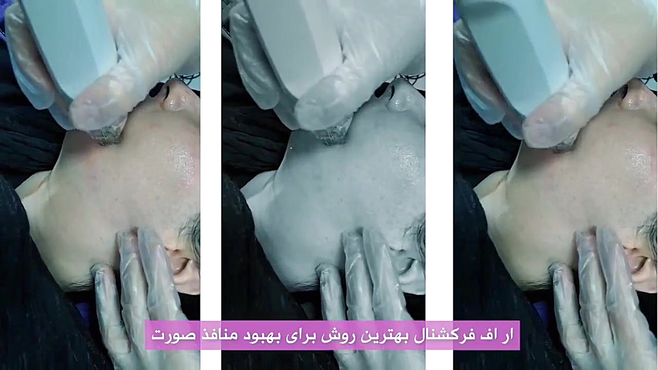 آر اف فرکشنال برای مراجعه کننده عزیز دکتر صدیقه نائیجی | متخصص پوست و مو در قم