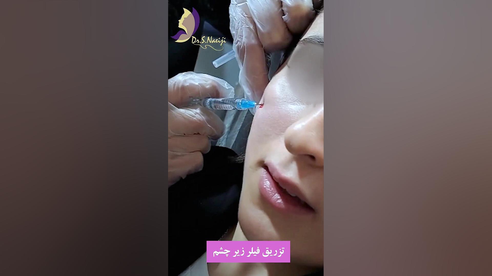 تزریق فیلر زیر چشم دکتر صدیقه نائیجی | متخصص پوست و مو در قم