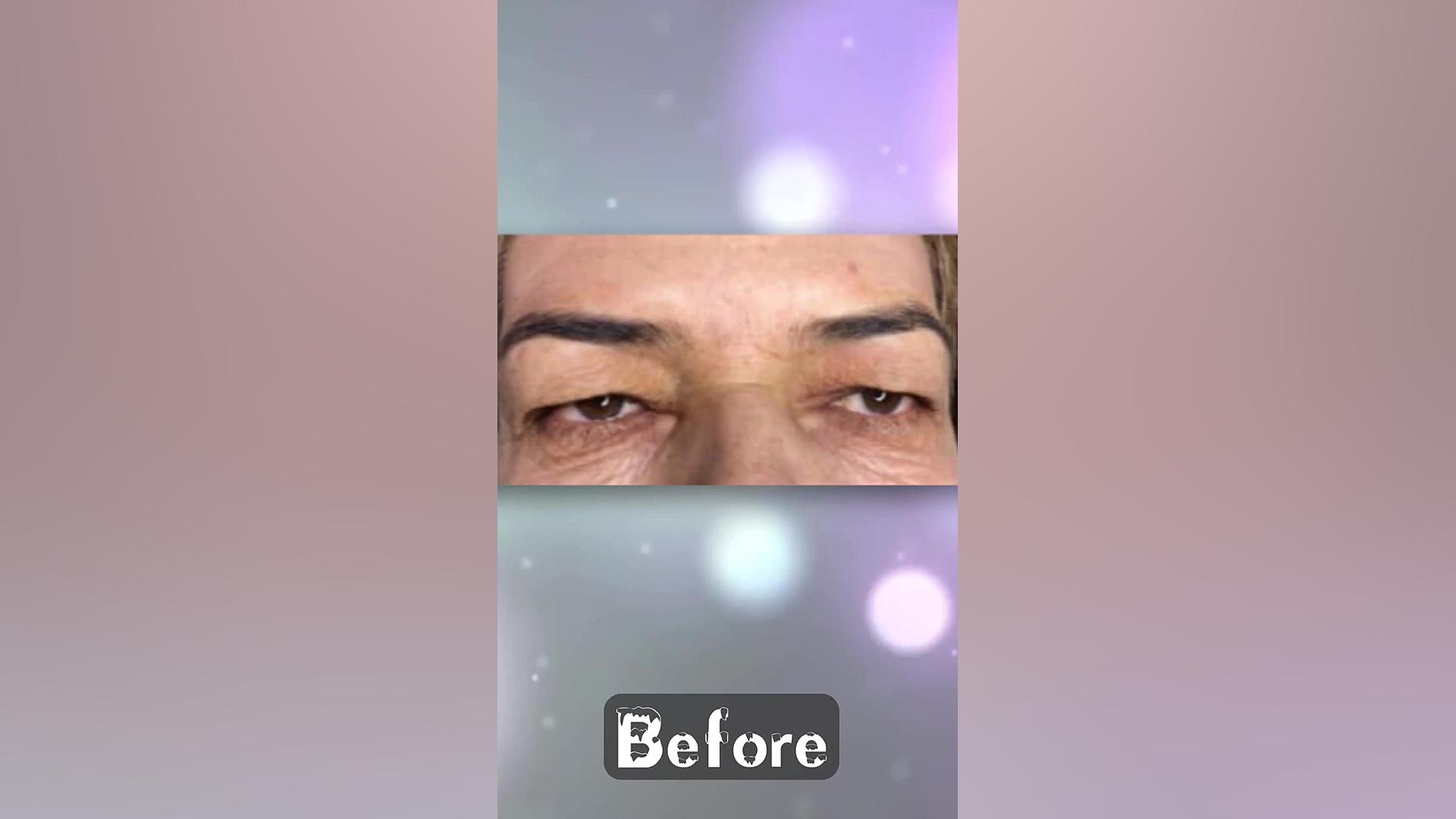 بلفاروپلاستی مراجعه کننده عزیزمون دکتر صدیقه نائیجی | متخصص پوست و مو در قم