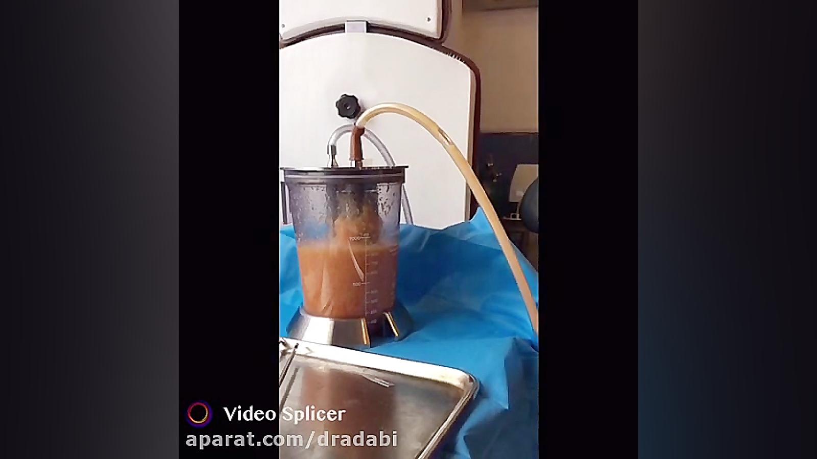 جمع كردن كردن چربى براى تزریق دکتر مرتضی ادبی (متخصص پوست،مو و زیبایی)