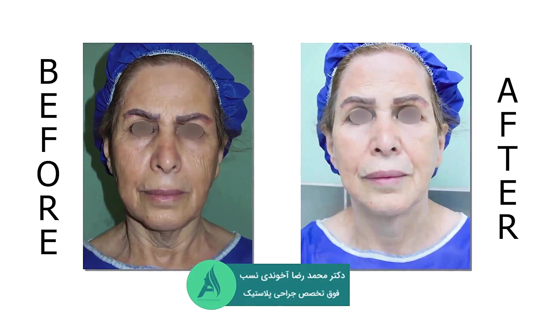 جراحی لیفت صورت به روش دیپ یلین هایپوفلکسی