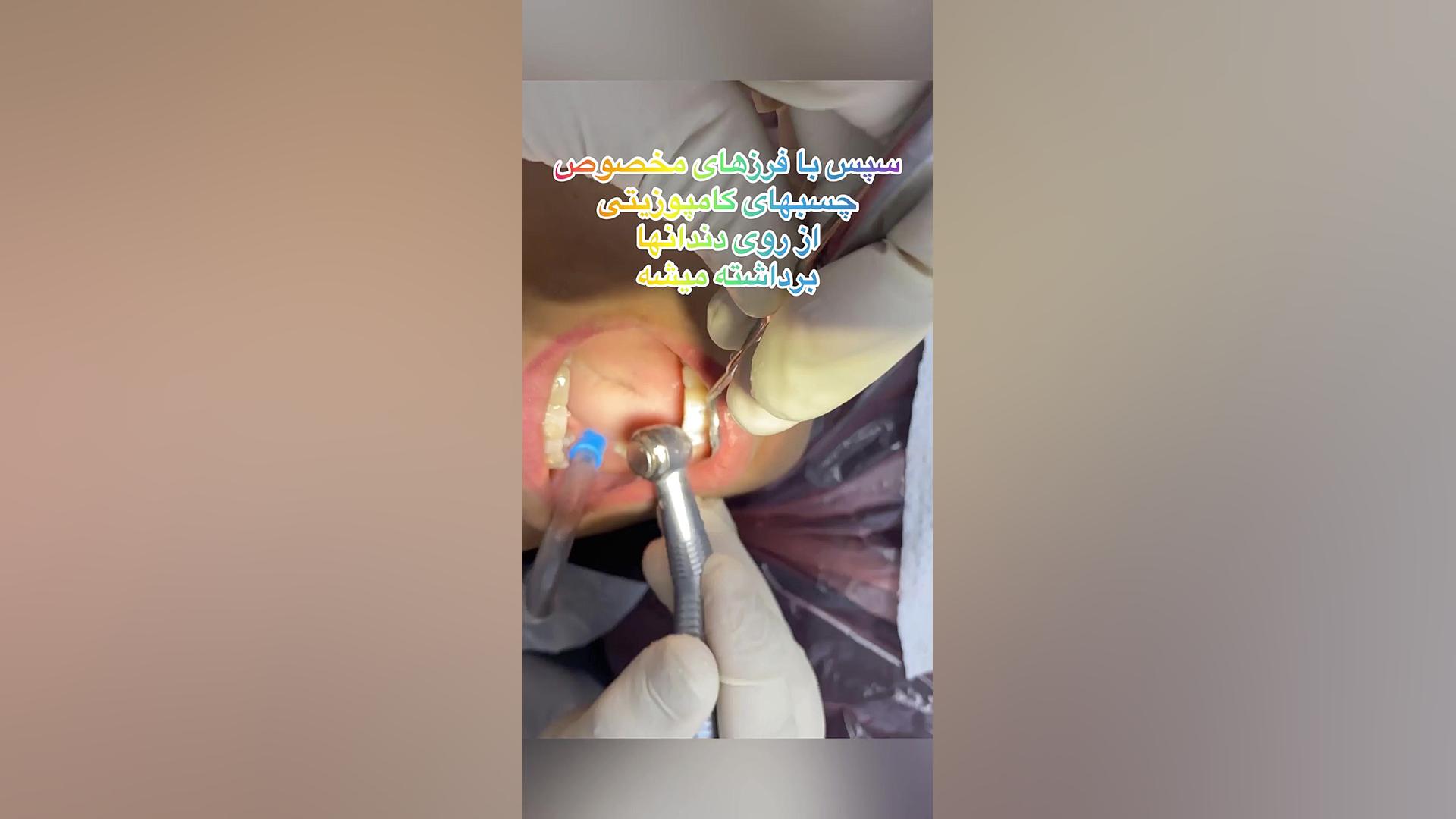 چطور براکتها در جلسه ی اخر ارتودنسی برداشته میشود؟ دكتر مهدي فهيمي هنزائي