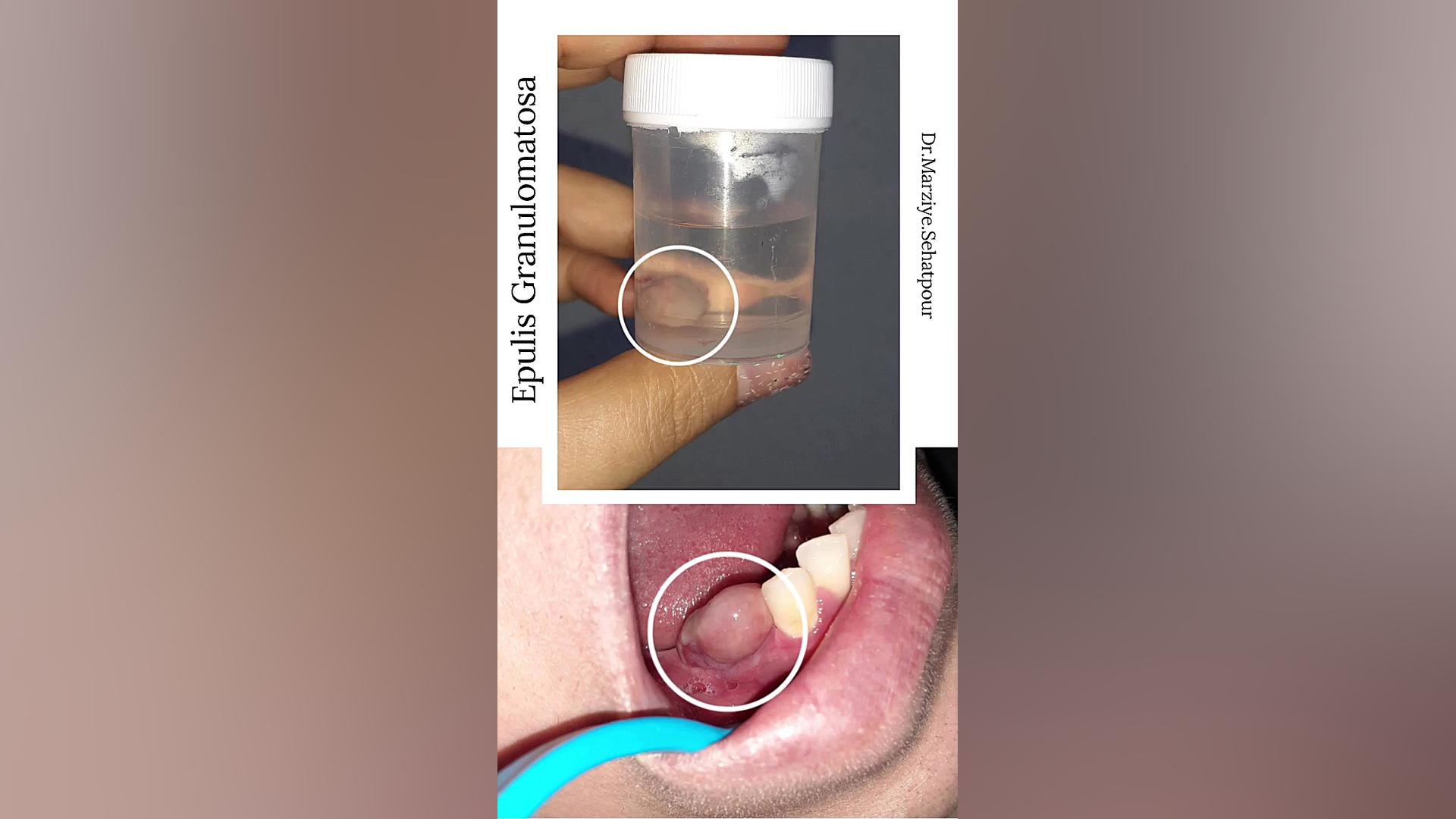 نمونه برداری دهان (دکتر مرضیه صحت پور)drmarziyesehatpour