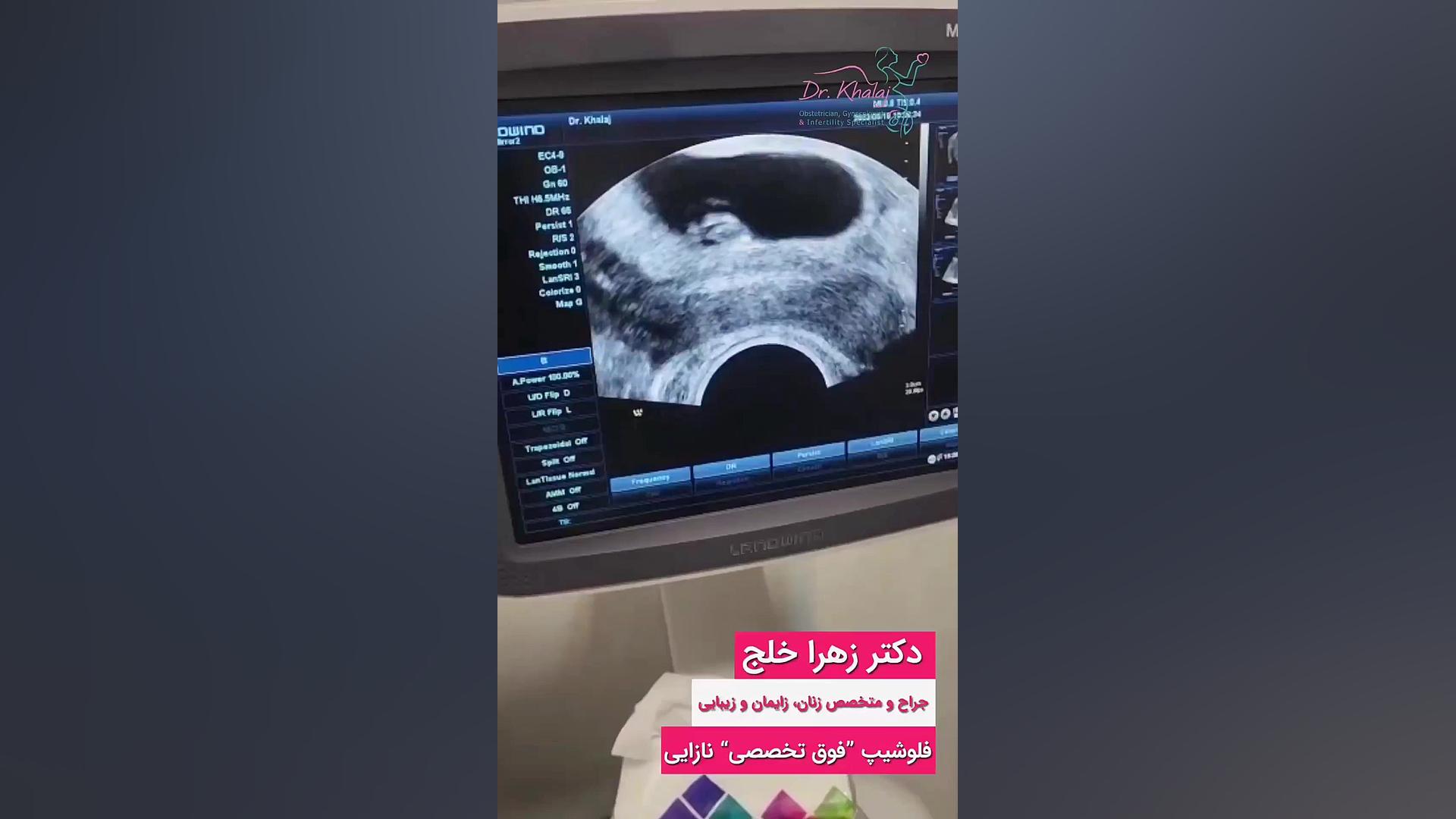 بارداری بعداز ۸ سال انتظار با دومین انتقال جوانسازی پوست