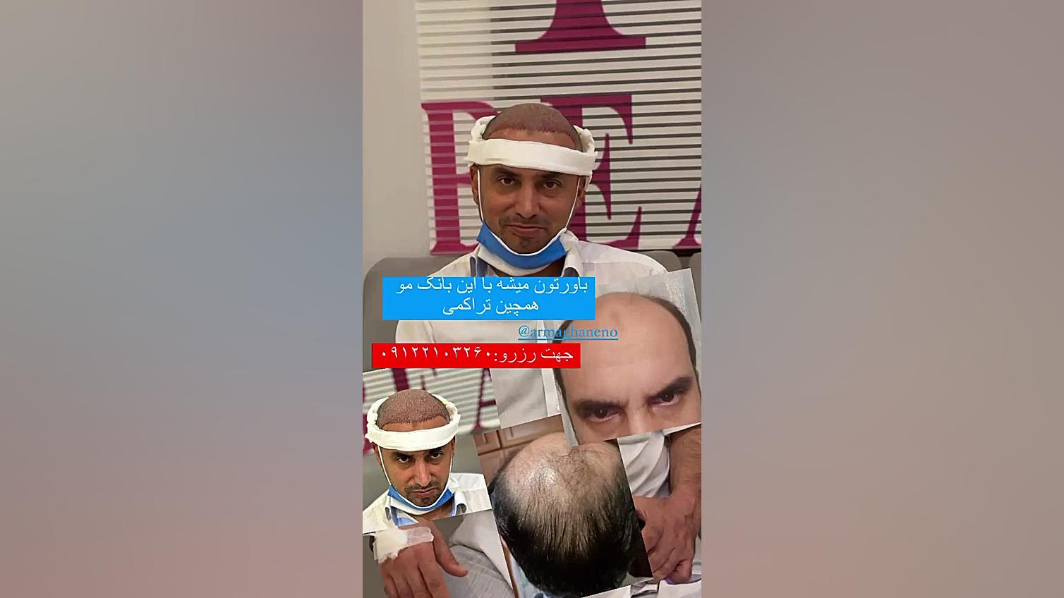 کاشت مو بدون بانک بیماری مایکلیناپاتی