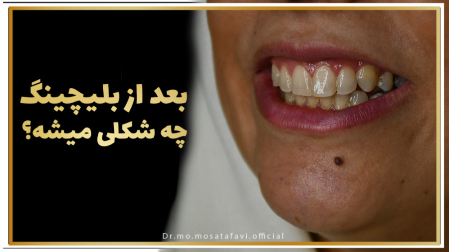 بلیچینگ فک بالا و پایین برداشتن خال