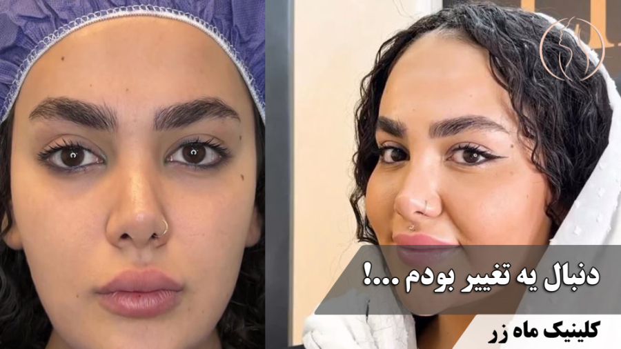 دوستام کلینیک ماه زر رو معرفی کردن! ( تزریق چربی بایوفت ) زمان39ثانیه