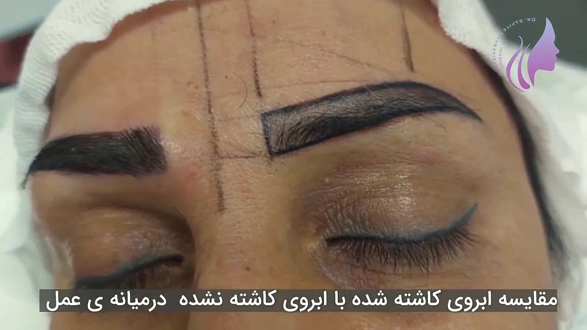 تاثیر شگفت انگیز کاشت اببرو دکتر صفیه چعباوی زاده