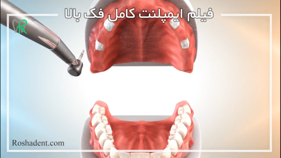 فیلم ایمپلنت دندان کامل فک بالا رتروگناتیا