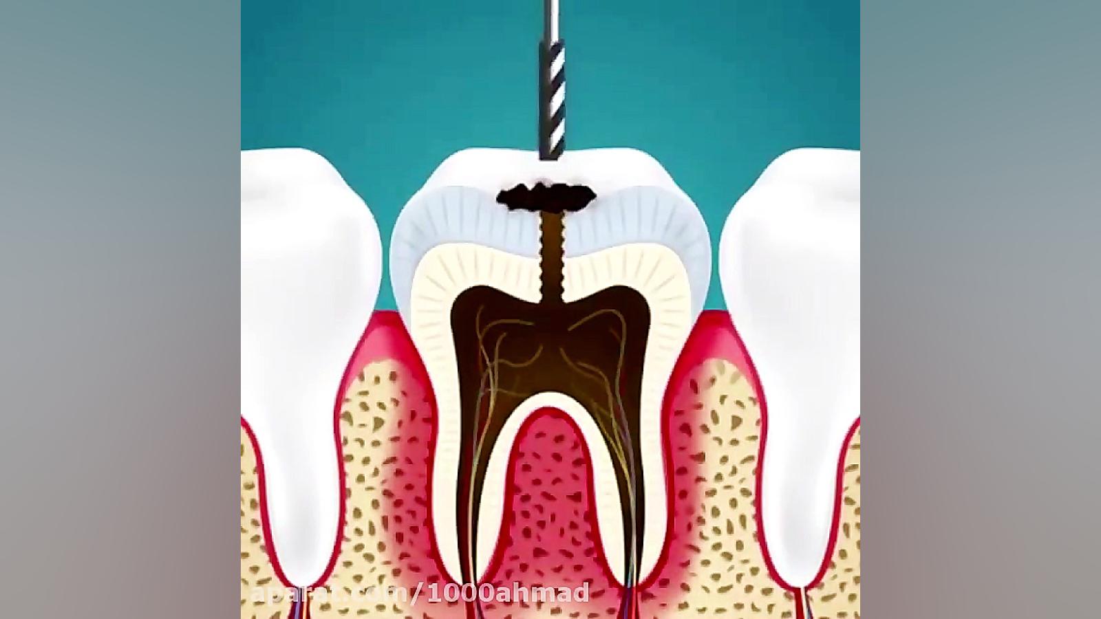 انیمیشن Gif روش عصب کشی و ترمیم دندان پوسیده و خراب جراحی پف زیر چشم