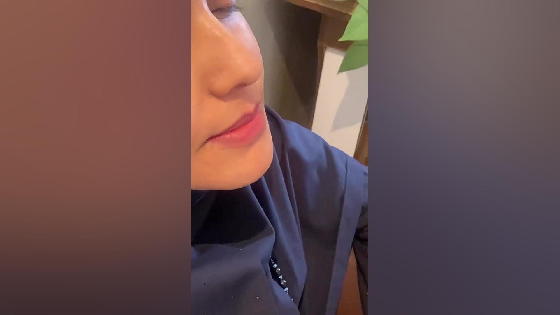 اصلاح لبخند لثه ای در کلینیک لیان شیراز سیستم ارزیابی هیستوترمیک