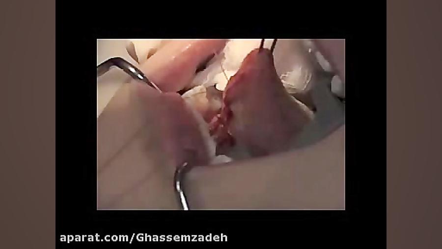 جراحی تیغه گوشتی زیر زبان به روش معمول دكتر امان اله قاسم زاده