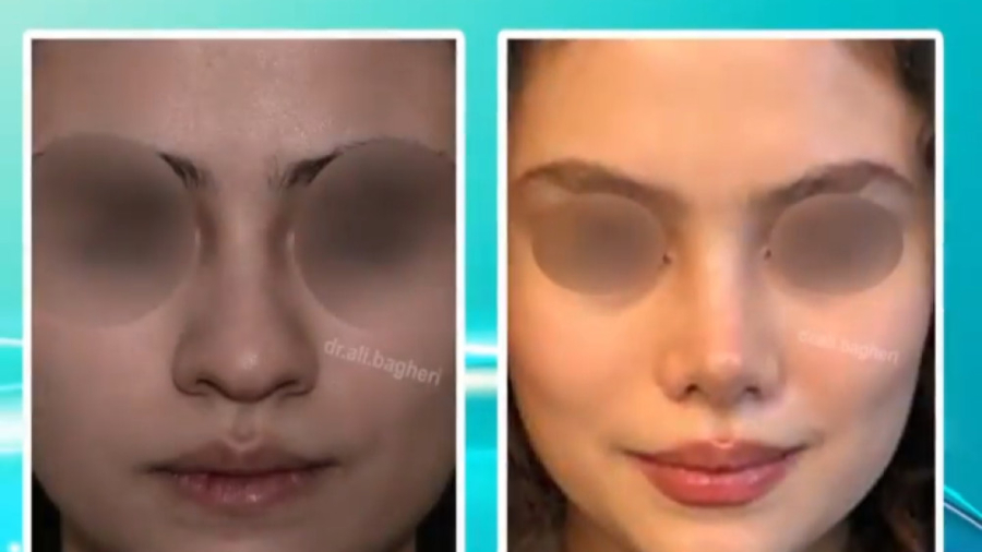 جراحی زیبایی بینی دکتر علی باقری حق