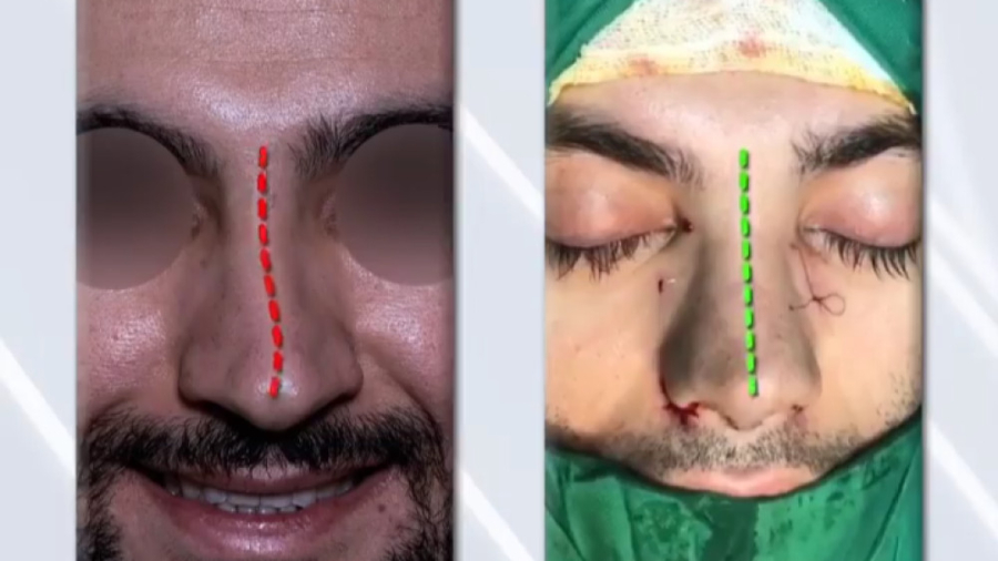 جراحی زیبایی بینی در آقایان دکتر علی باقری حق