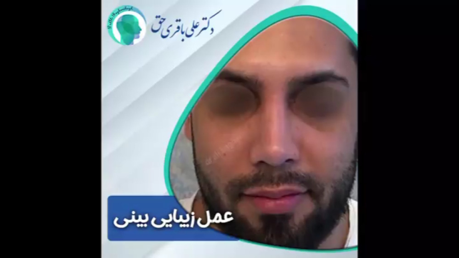 رینوپلاستی در آقایان دکتر علی باقری حق
