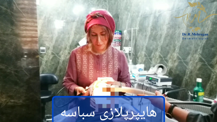 هایپرپلازی سباسه دکتر ریحانه مهرگان