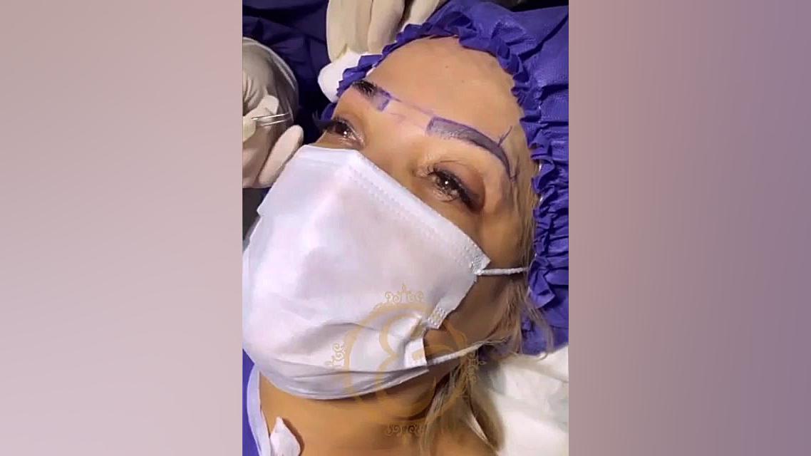 کاشت ابرو بدون درد و خونریزی کلینیک تخصصی پوست و مو تندیس سلامت