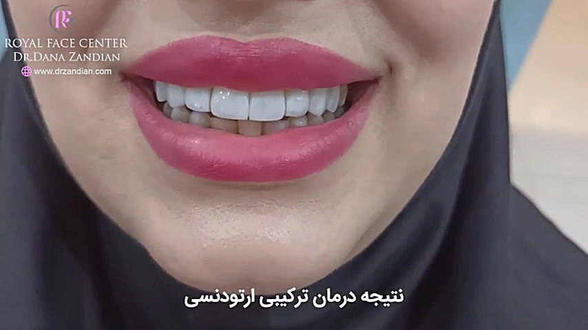 درمان ارتودنسی - درمان ارتودنسی بصورت ثابت و شفاف دکتر دانا زندیان