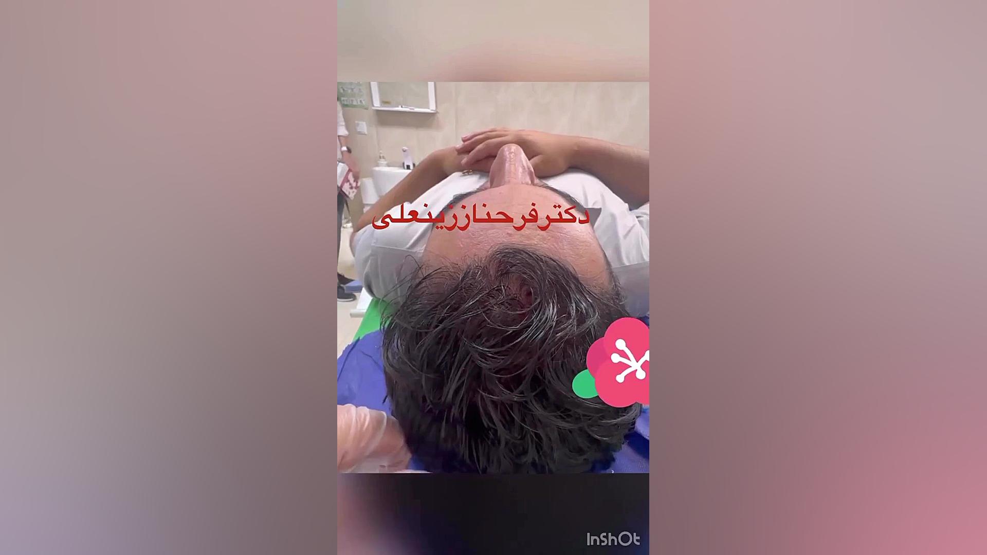 رضایت مراجعه کننده کلینیک پارس زنجان از PRP مو به منظور درمان ریزش مو دکتر فرحناز زینعلی - متخصص پوست، مو، زیبایی زنجان