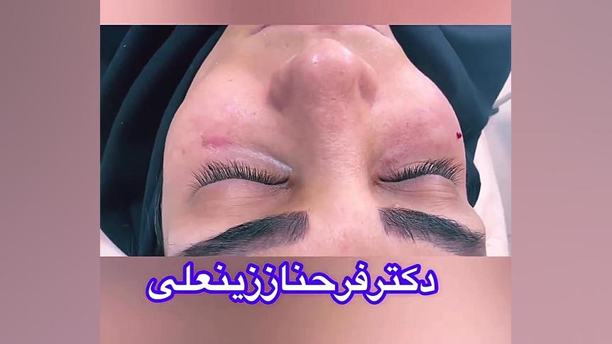 تزریق ژل زیر چشم دکتر فرحناز زینعلی - متخصص پوست، مو، زیبایی زنجان