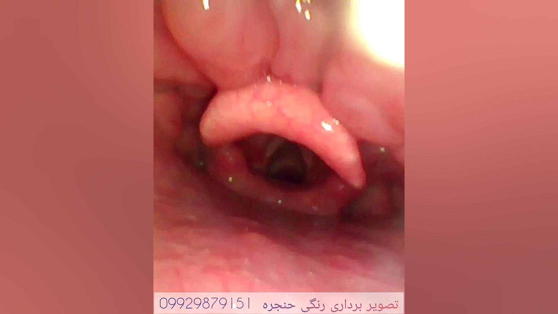 تصویر برداری رنگی از حنجره خانم چهل ساله دارای گرفتگی صدا اصلاح فرم صورت