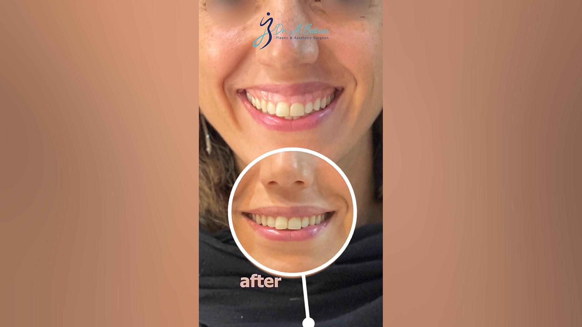 اصلاح لبخند لثه ای لیپوماتیک