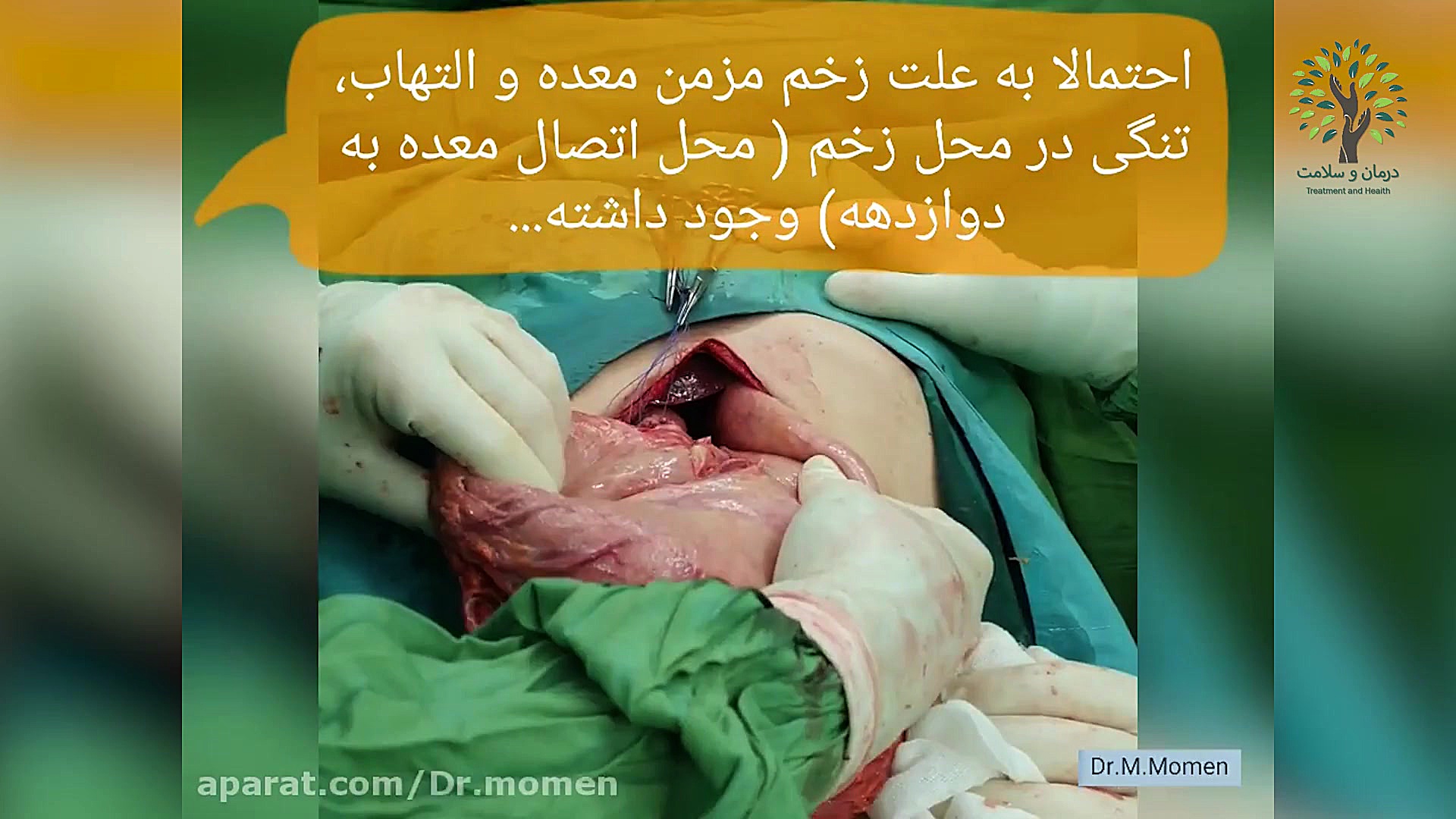 آیا زخم معده سوراخ می شود؟ لیفت ابرو