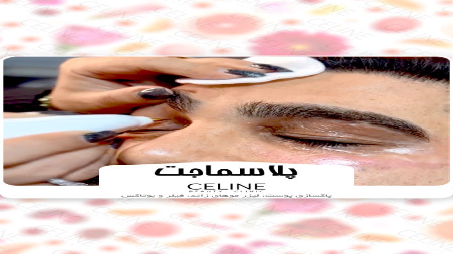پلاسماجت ایریدوتيكان