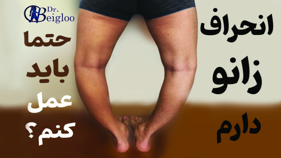 آیا انحراف زانو ( پای پرانتزی یا ضربدری) نیاز به جراحی دارد ؟ دکتر محمود جعفر بیگلو