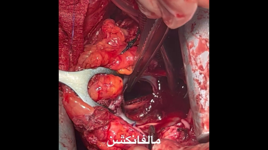 لخته دريچه مصنوعي تري كوسپيد-دكترحدادزاده زیبایی پوست