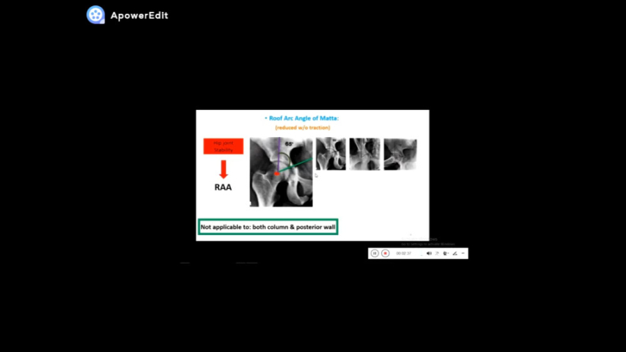 دررفتگی خلفی هیپ همراه با شکستگی دیواره خلفی استابولوم کیتی پری