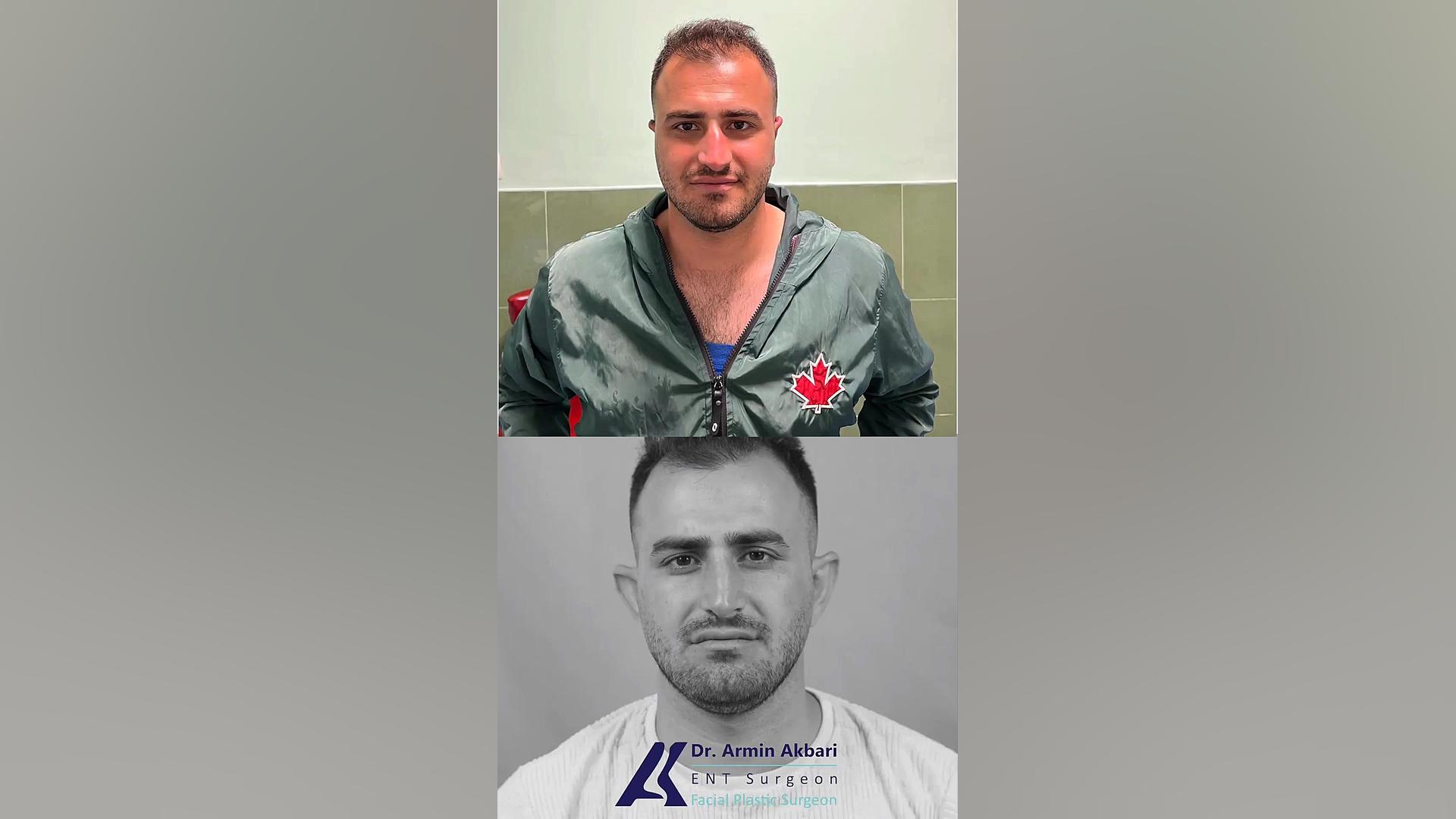 نمونه جراحی اتوپلاستی گوش ریبوسیکلیب